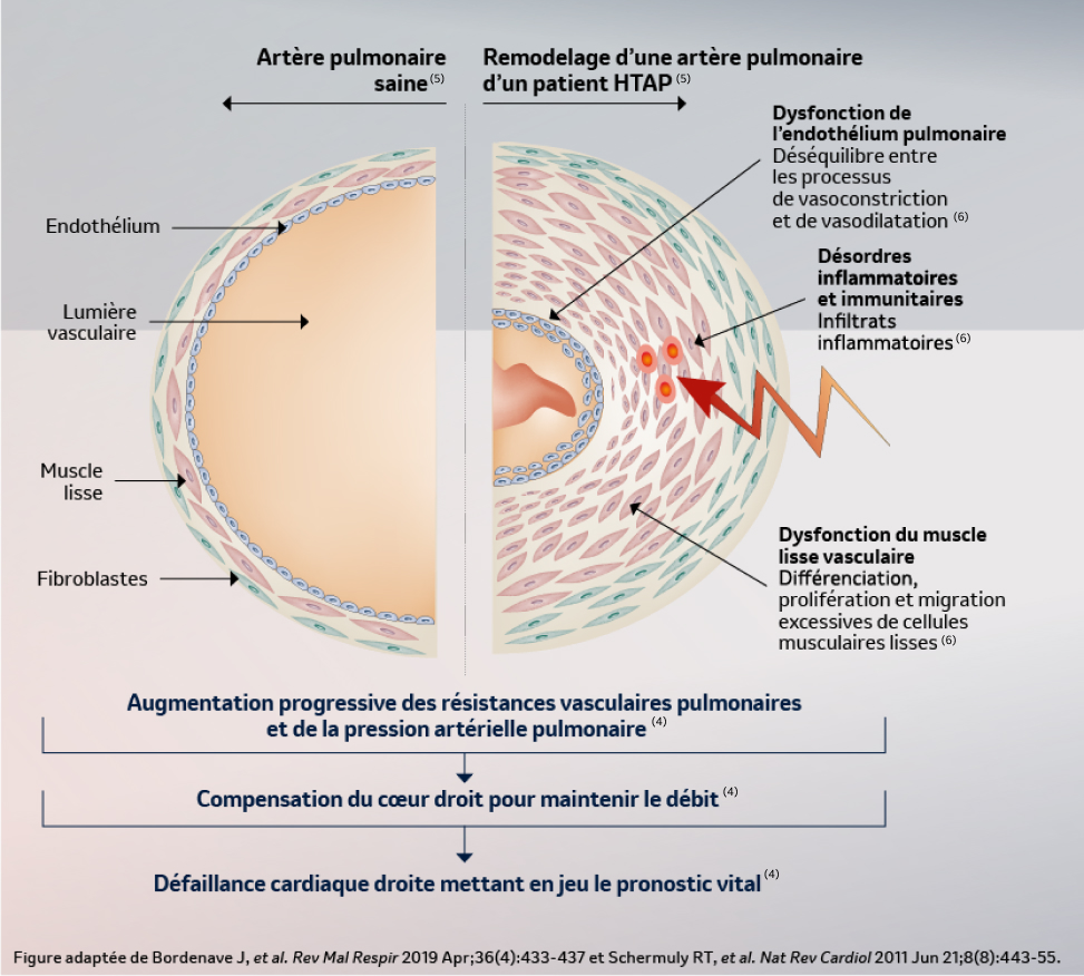 L'errance diagnostique face à l'HTAP