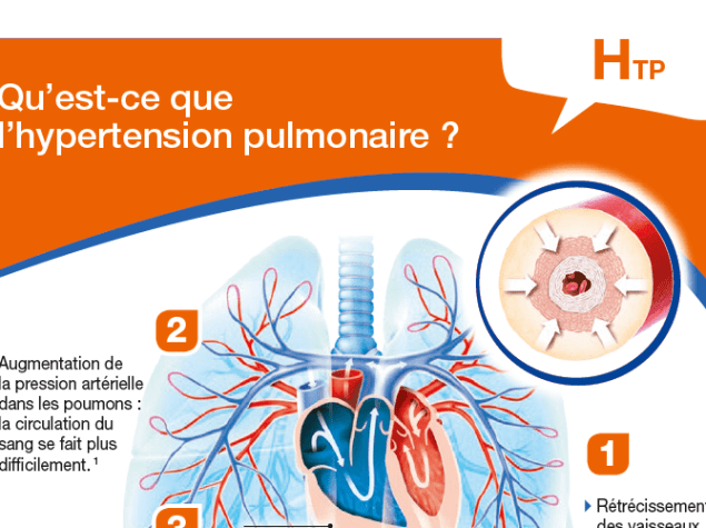 Qu'est-ce que l'hypertension pulmonaire ?