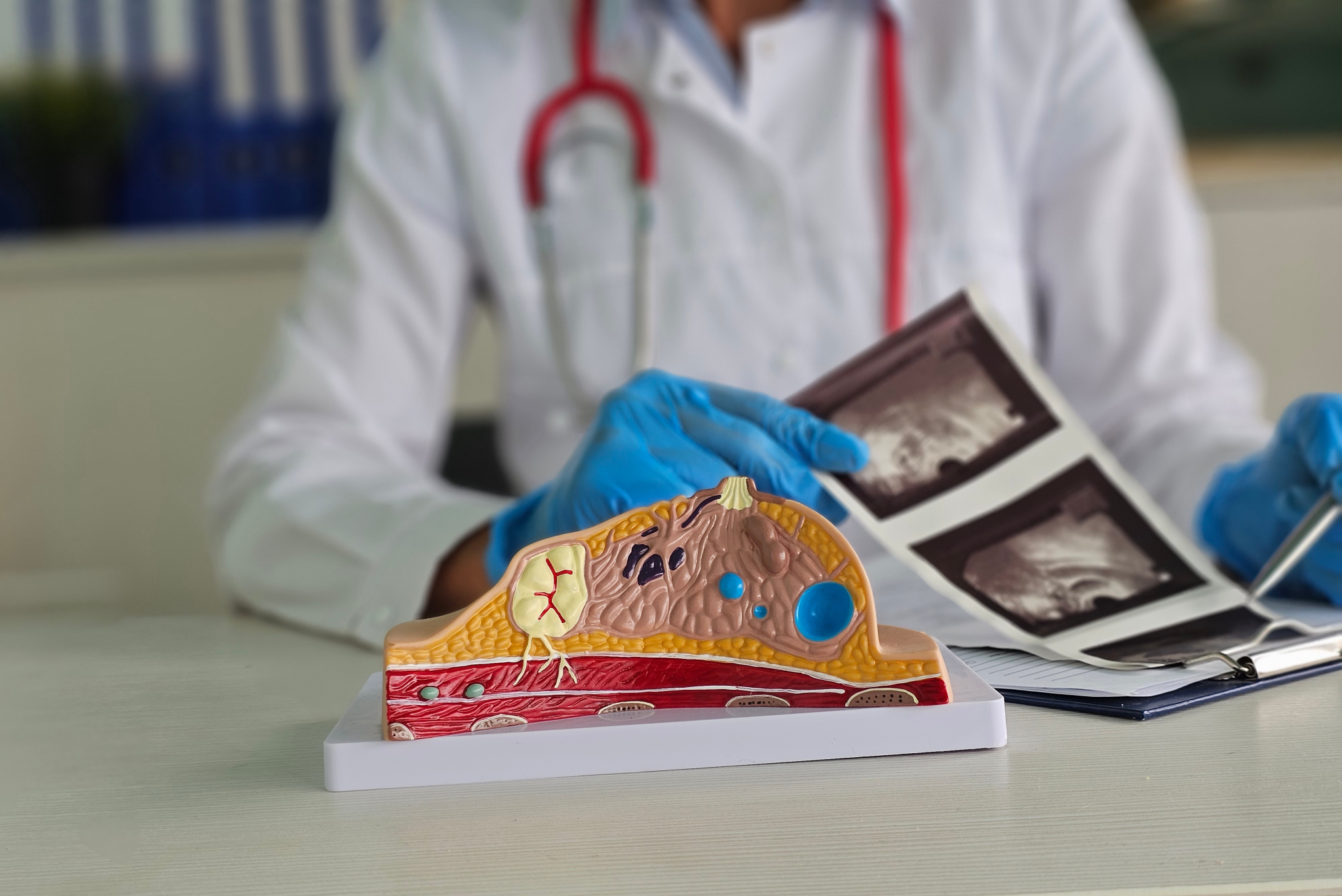 analyse d'un cancer du sein