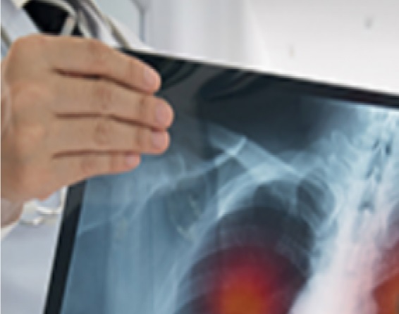 Hyperprogression-me_canismes-et-strate_ugies-de-pre_uvention