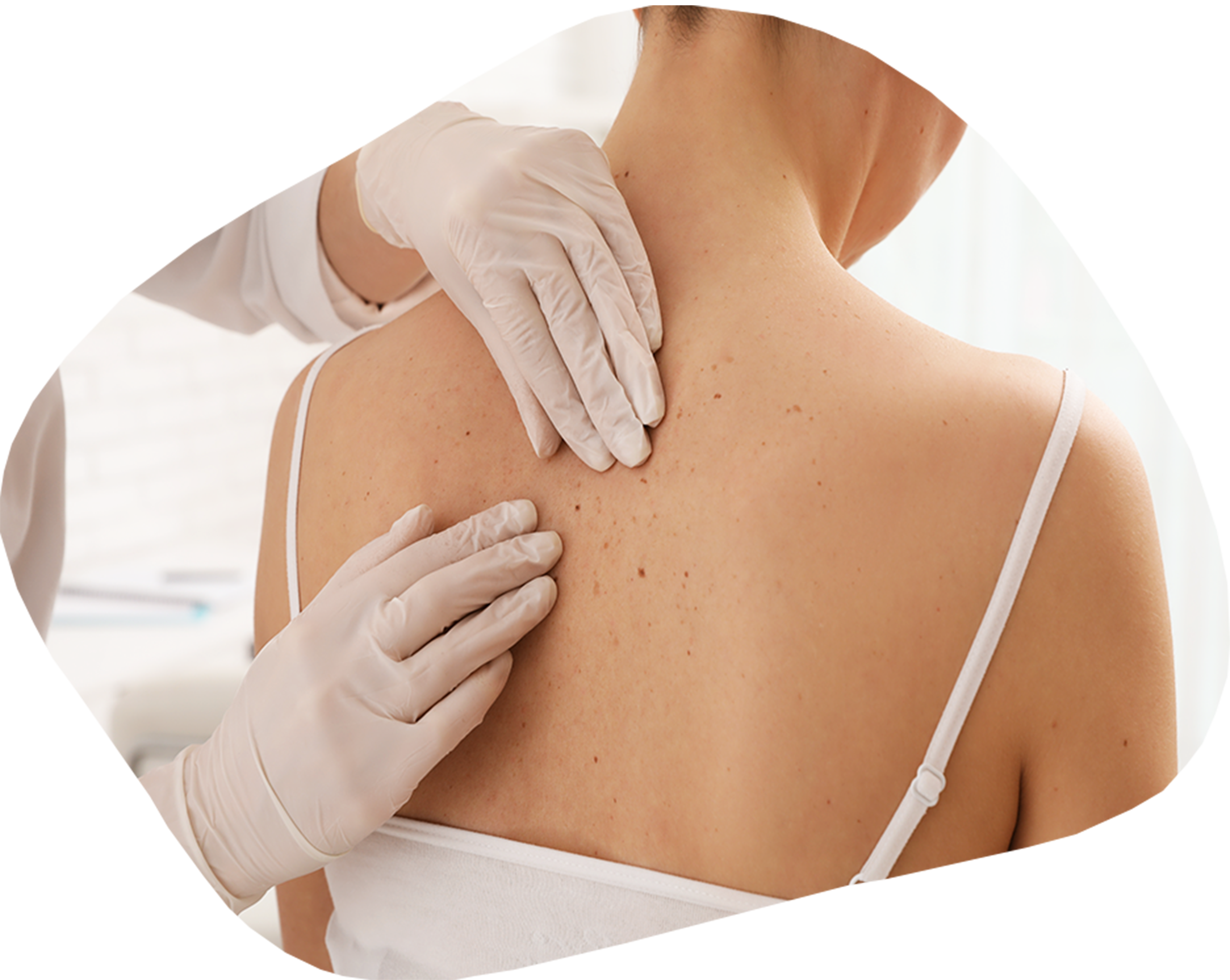 mélanome cancer de la peau