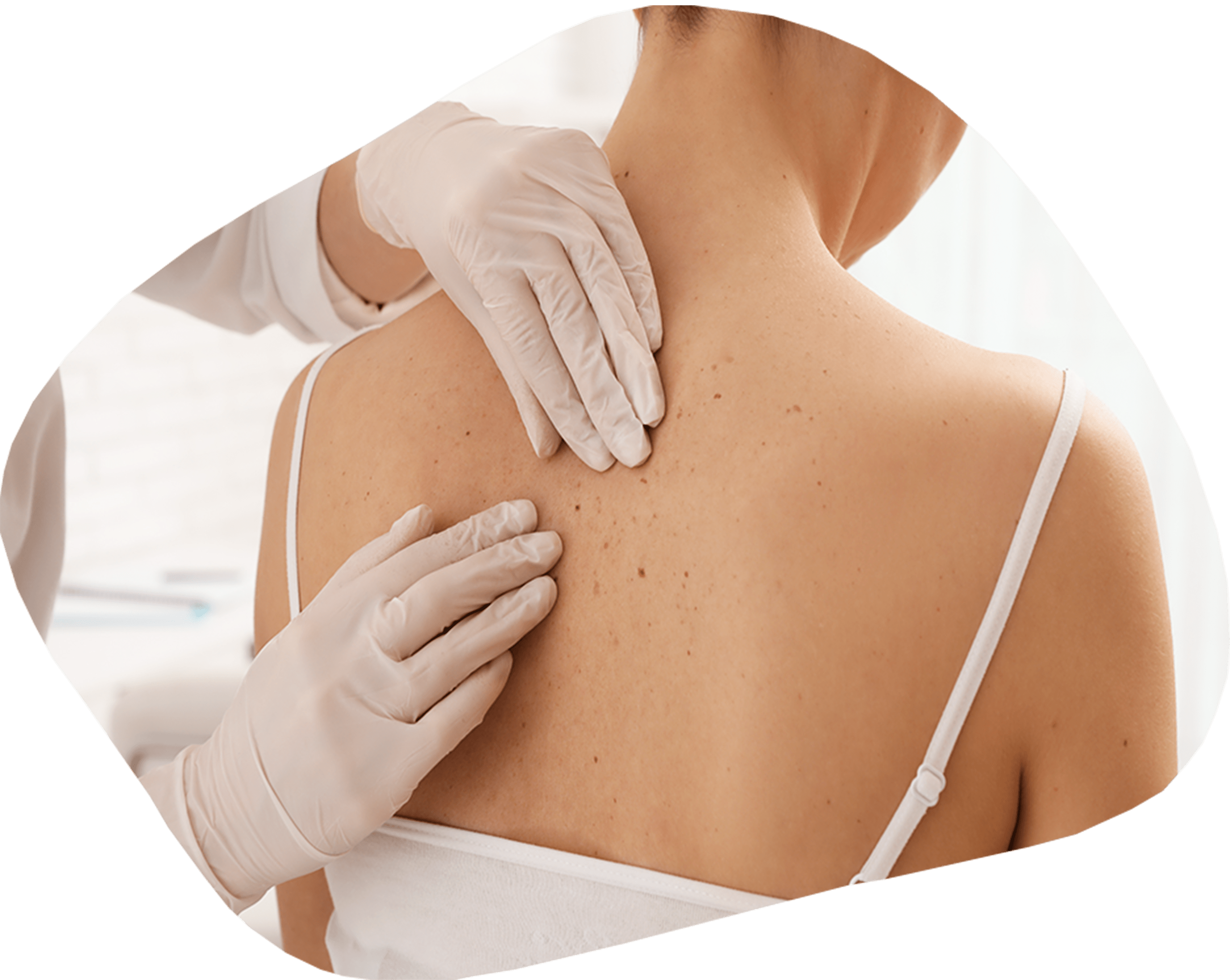 mélanome cancer de la peau