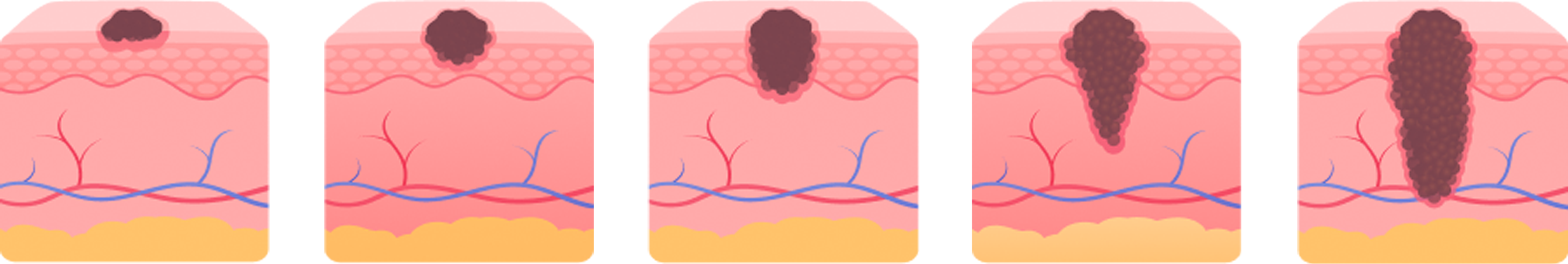 melanoma stage