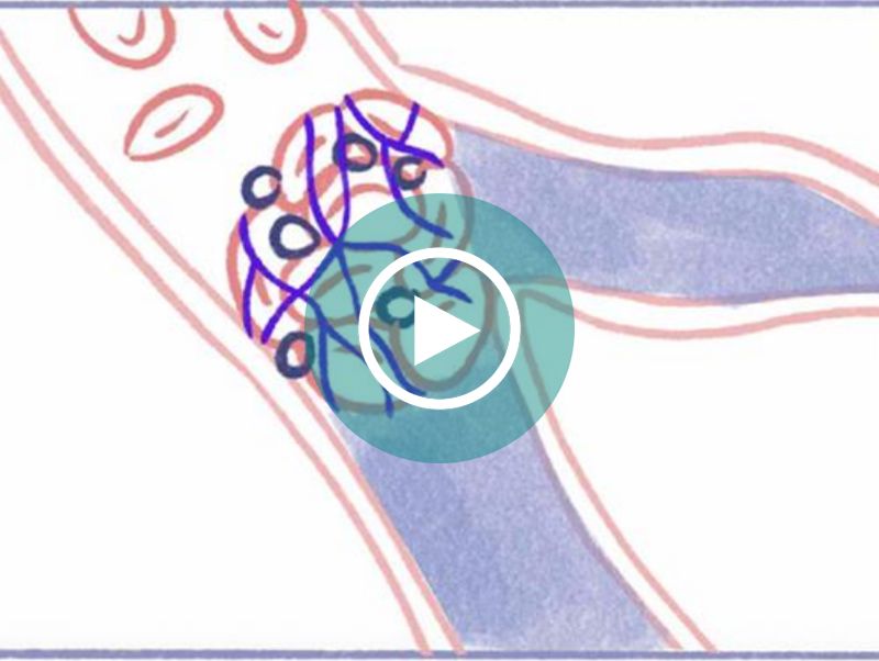 Liens entre embolie pulmonaire et HTP-TEC